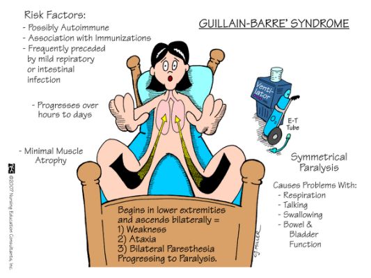 Guillain-Barre_Syndrome.jpg-388.cf