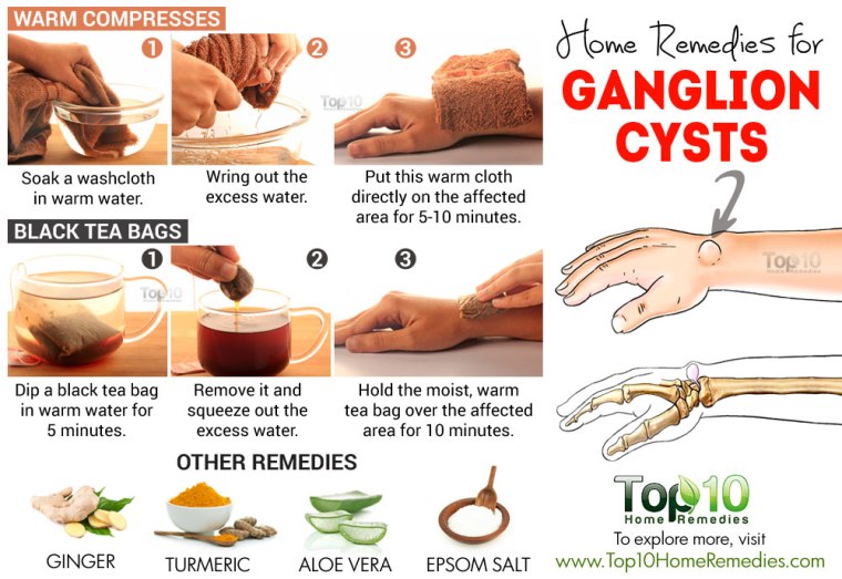 ganglion-cysts