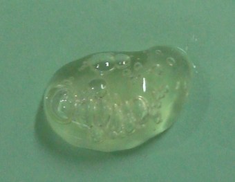 ganglion_cyst_wrist_dorsum_lictao_12may5_postasp_gel